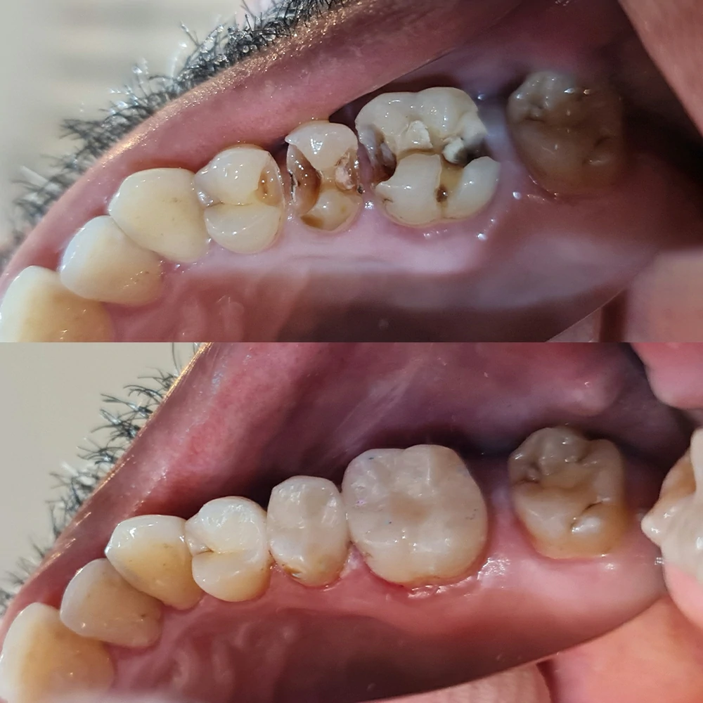 Decay Removal