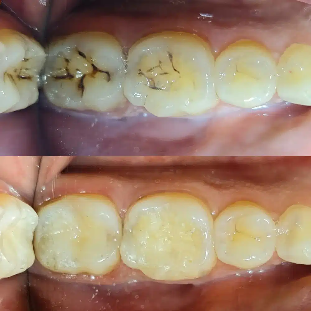 Restorative Composite Bonding
