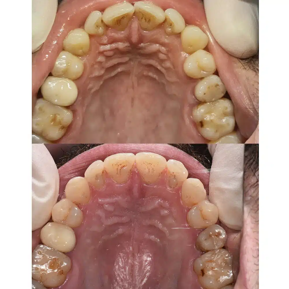 Clear Aligner Transformation