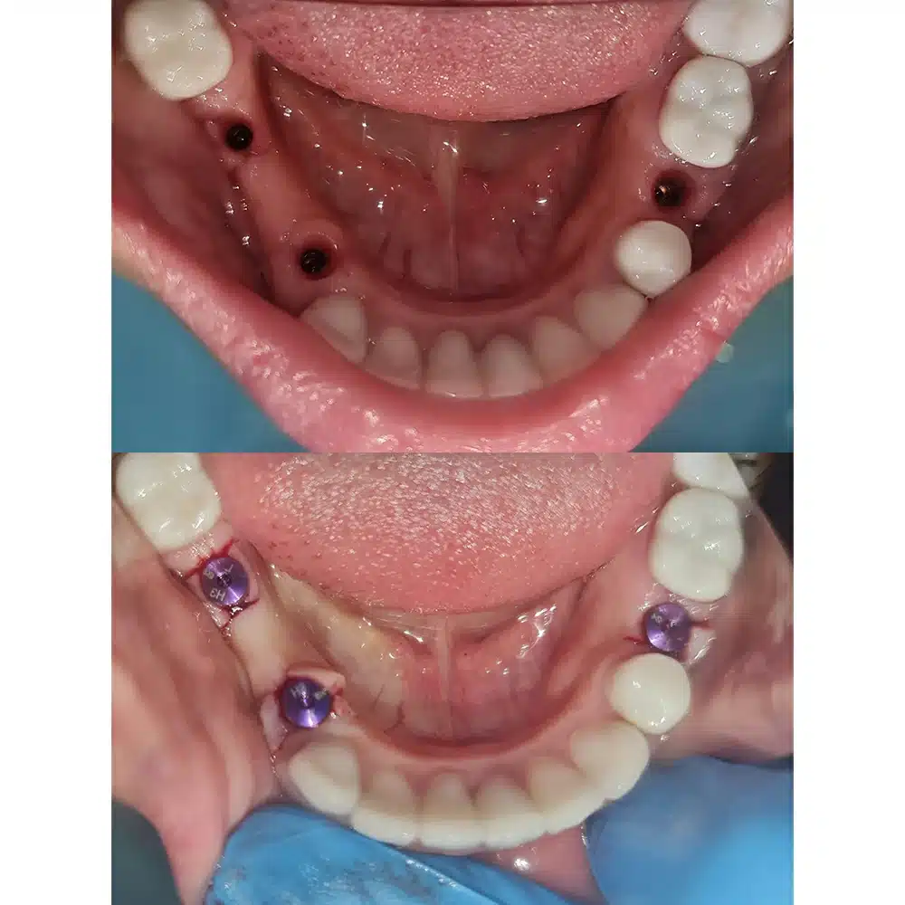 Dental Implant Restoration