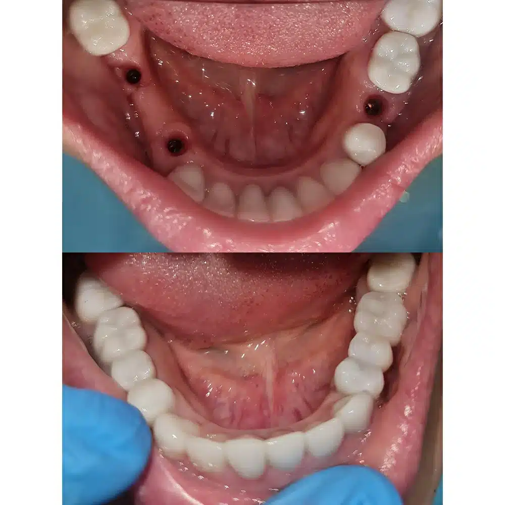 Implant Smile Rehabilitation