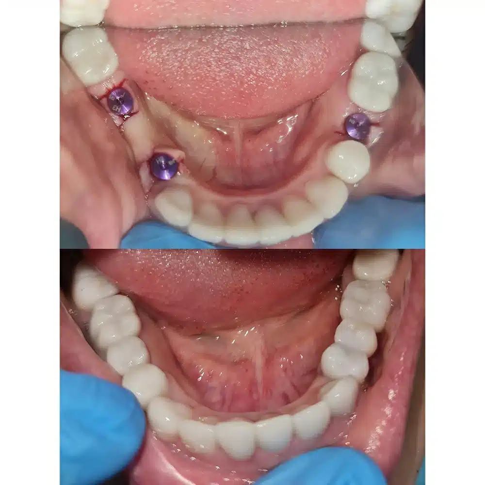 Full Implant Support