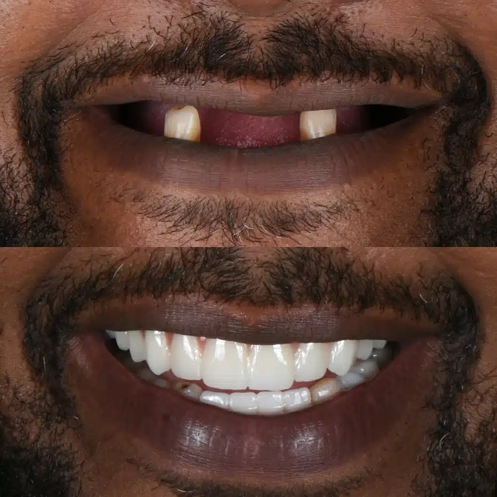 Aesthetic Implant Restoration