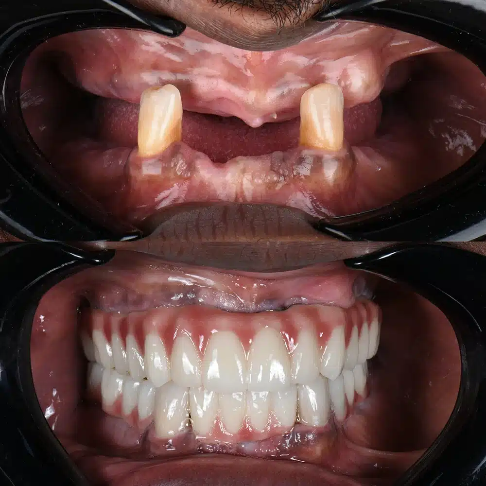 Aesthetic Implant Restoration