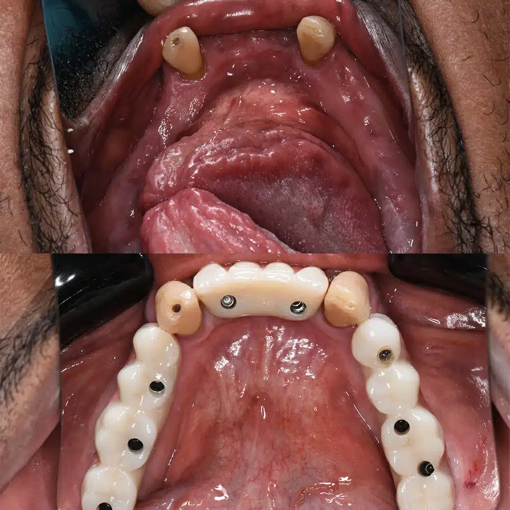 Aesthetic Implant Restoration