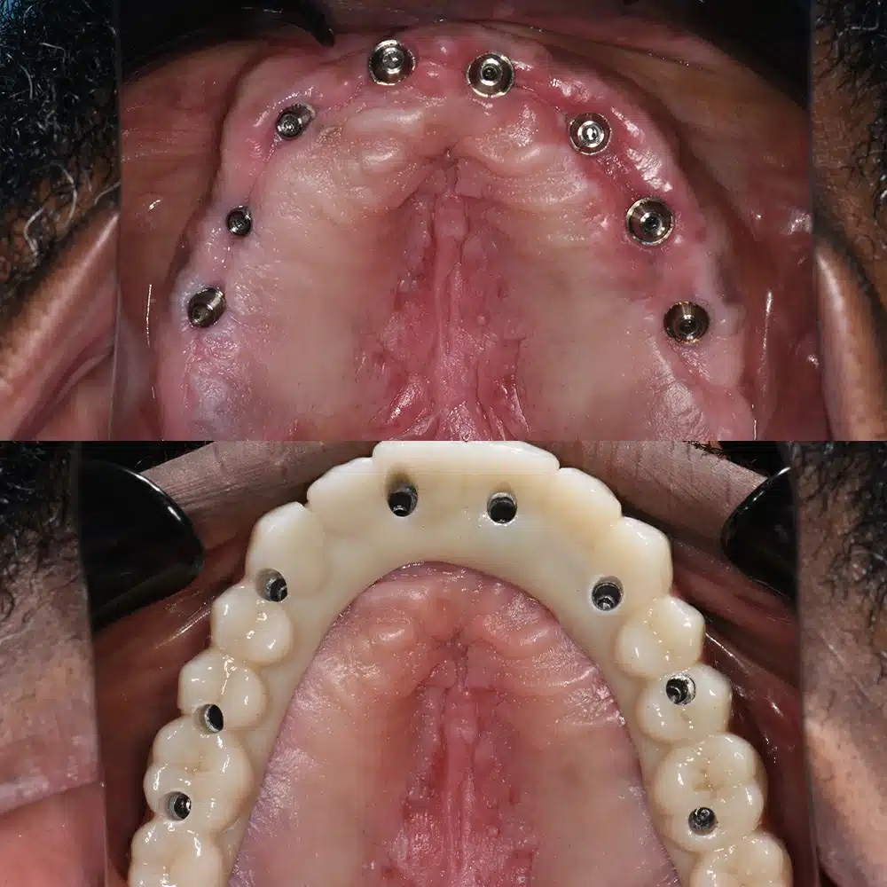 Aesthetic Implant Restoration