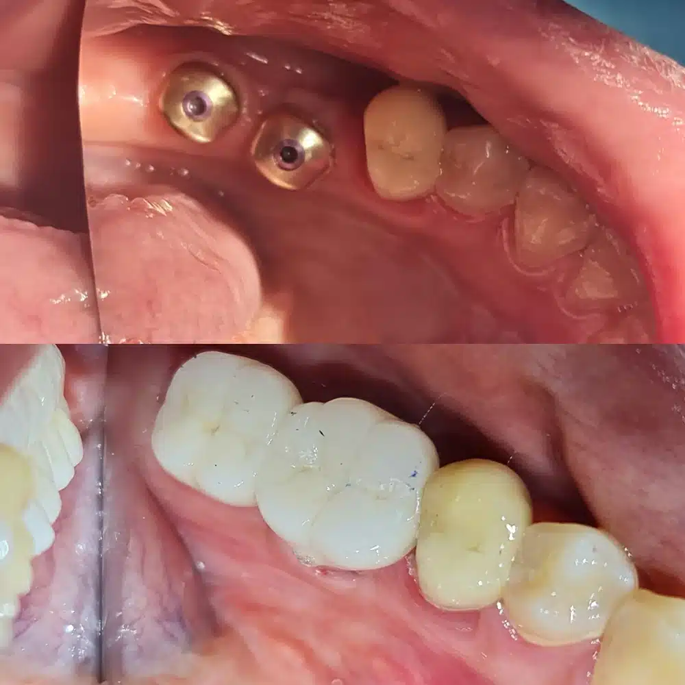Implant Case Restoration