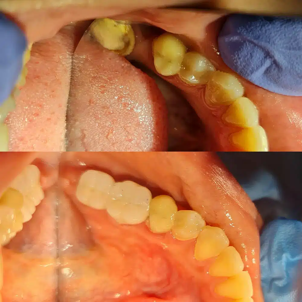 Dental Implant Reconstruction