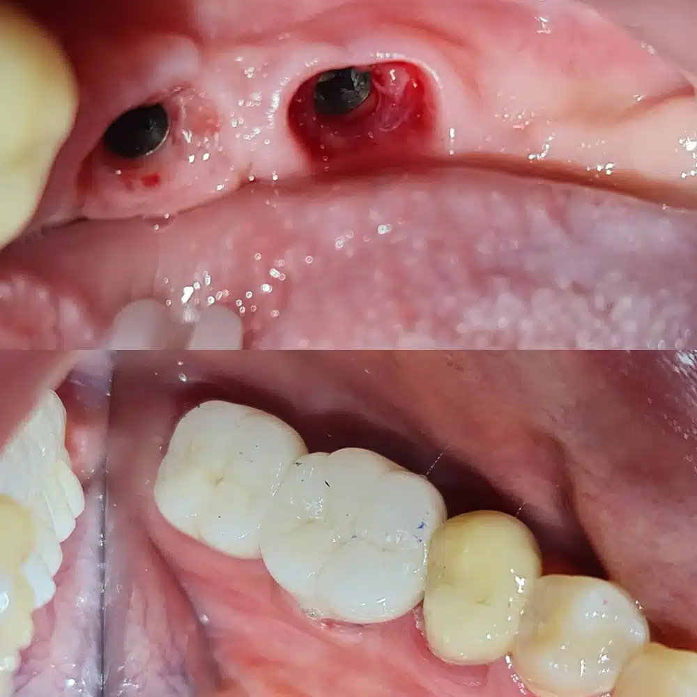 Implant Aesthetic Restoration