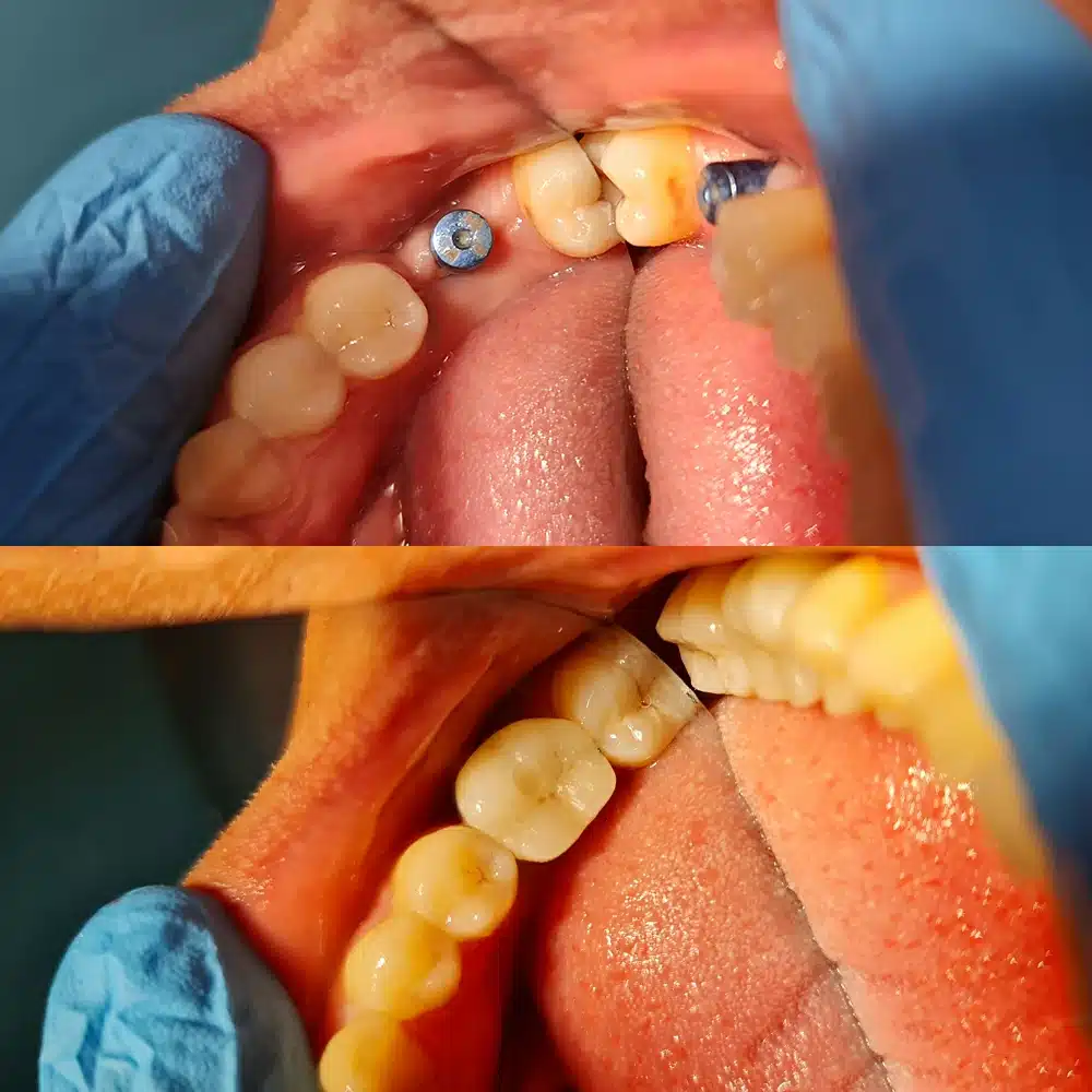 Single Dental Implant 