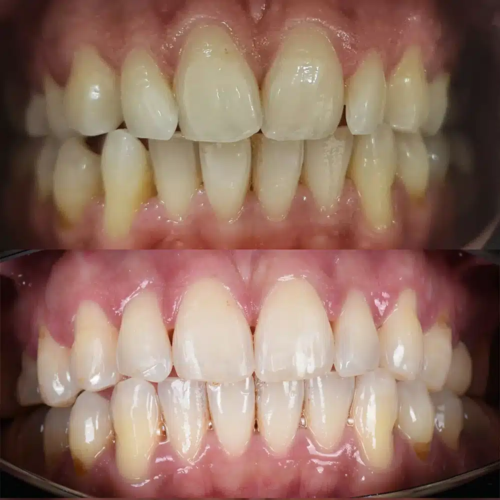 Orthodontic Refinement
