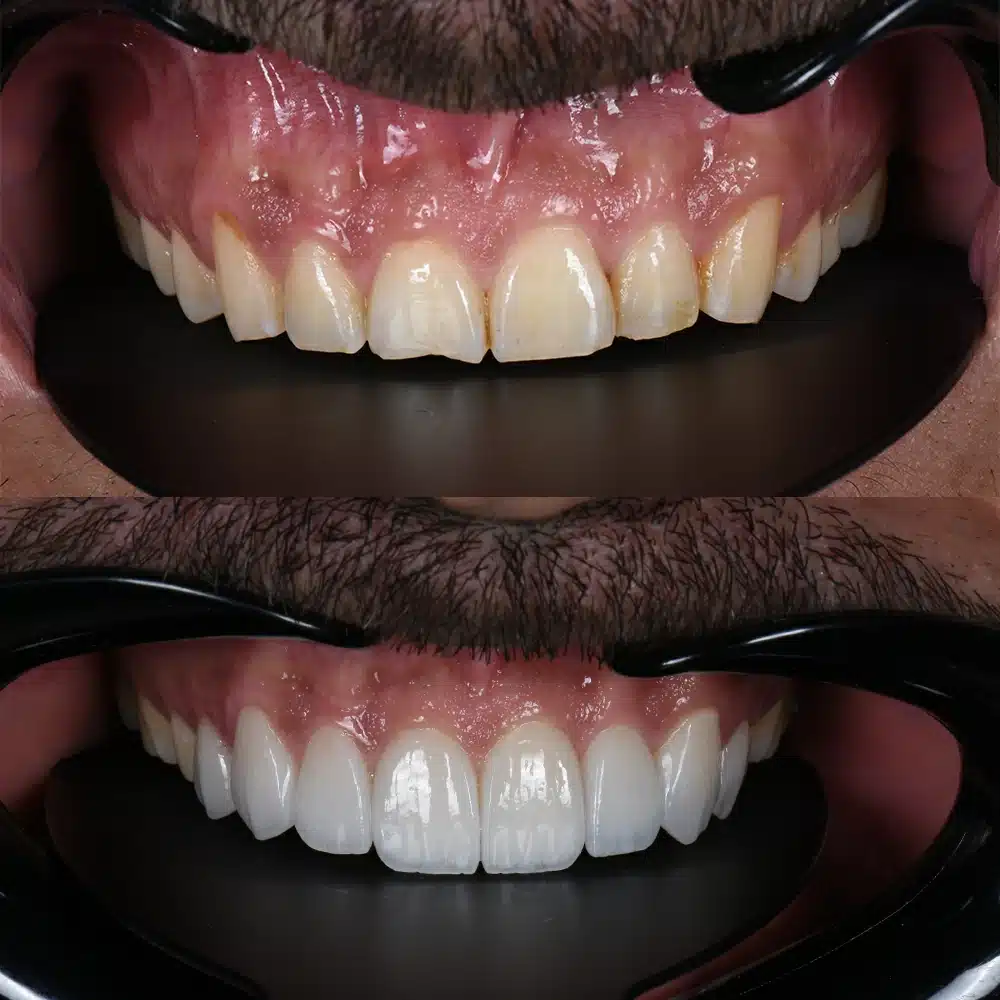 E-max Veneers