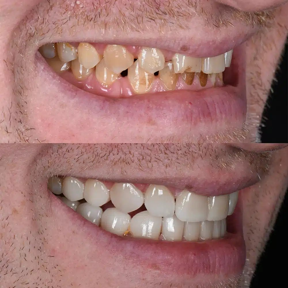Upper Veneers