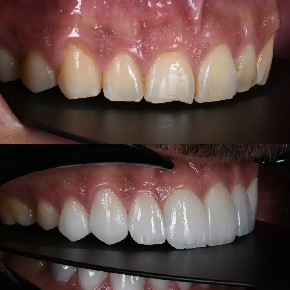 Cosmetic Veneers
