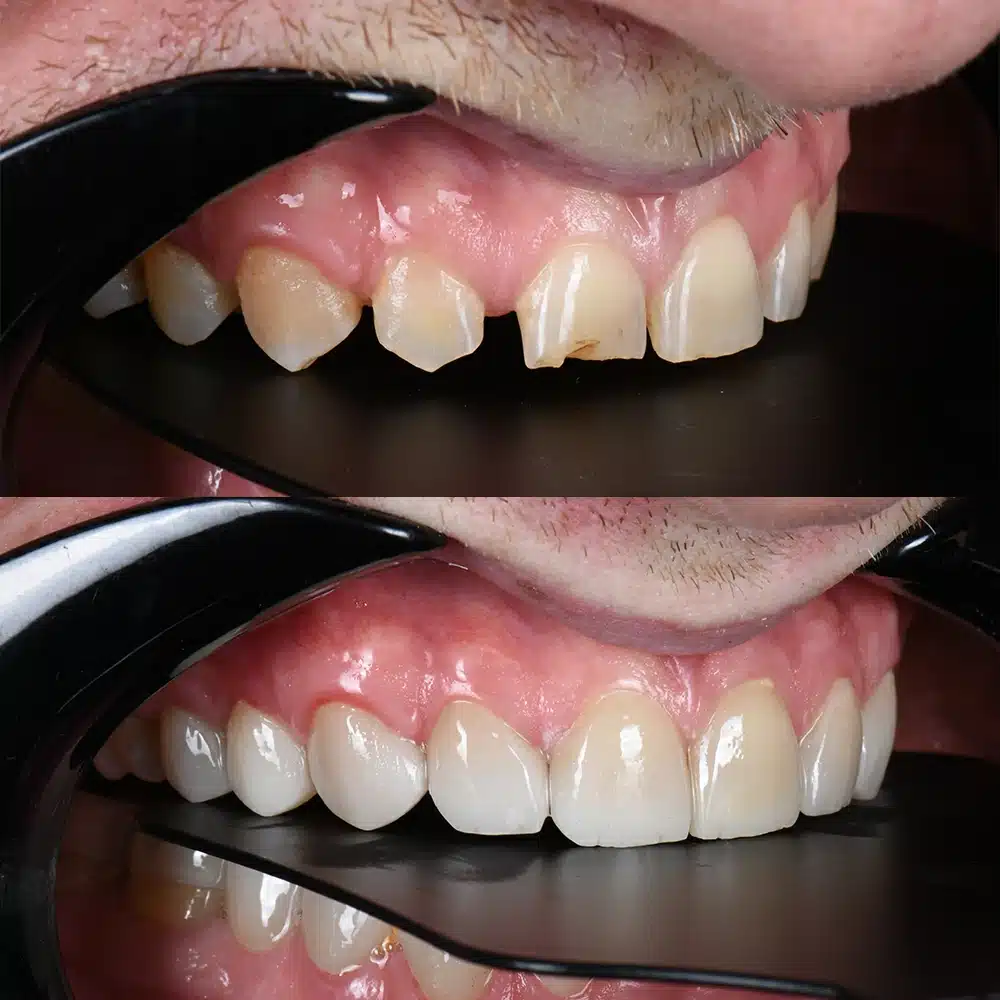 Full Smile Veneers