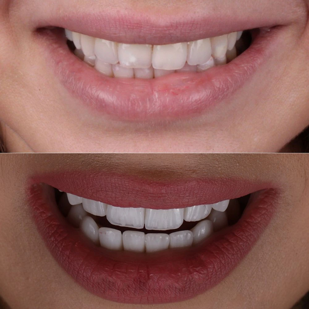 3D E-max Veneers