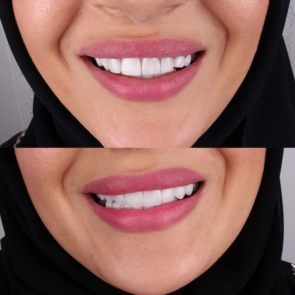 Full Smile Makeover