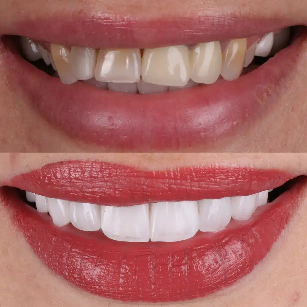 Cosmetic Veneers