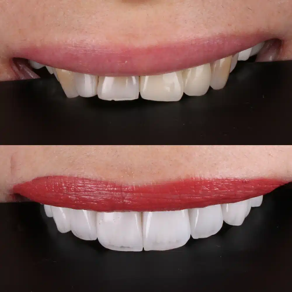 Cosmetic Veneers