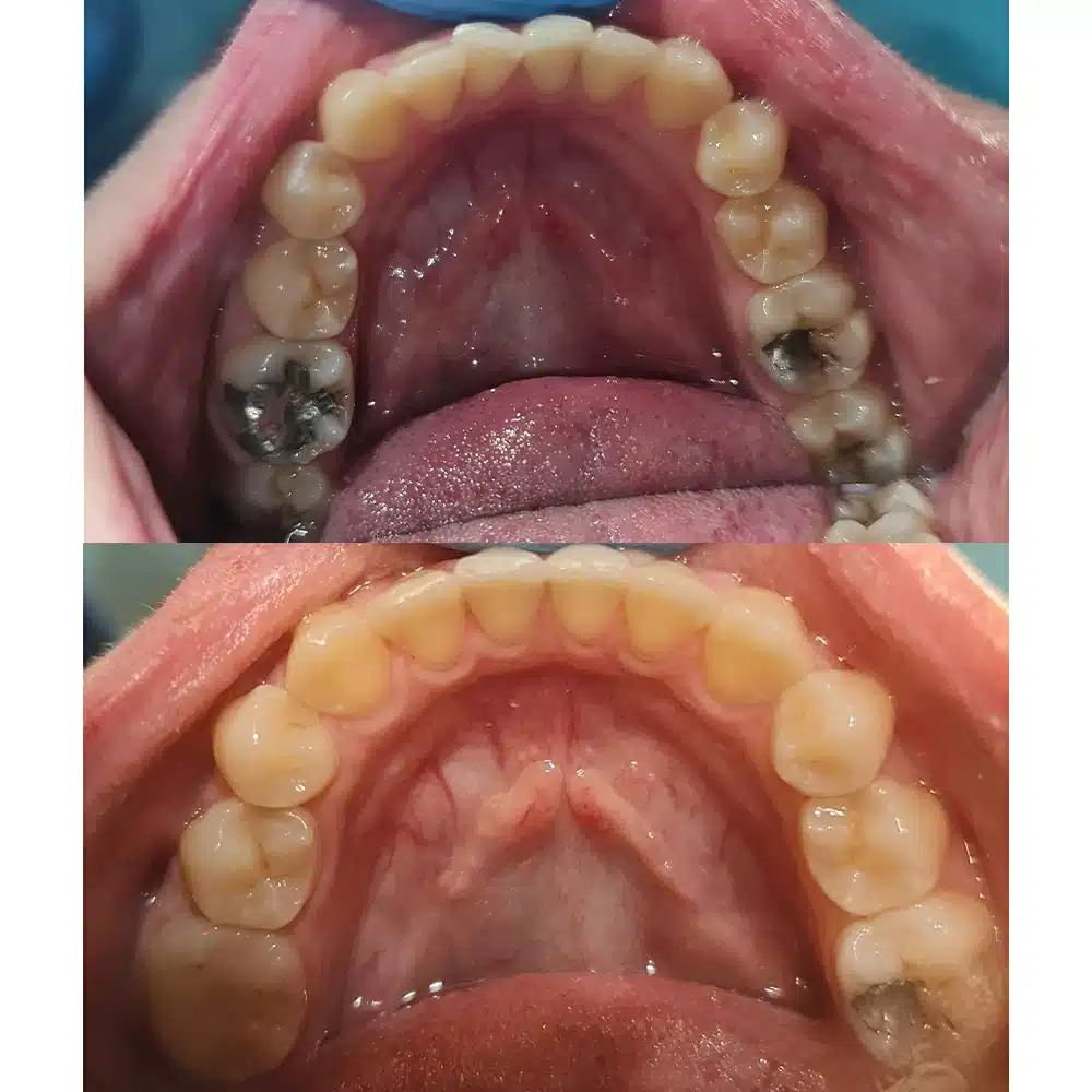 Clear Aligners