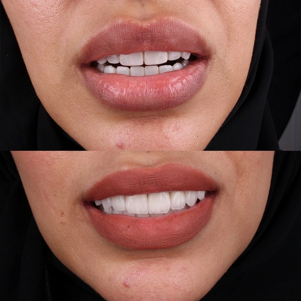 Smile Transformation