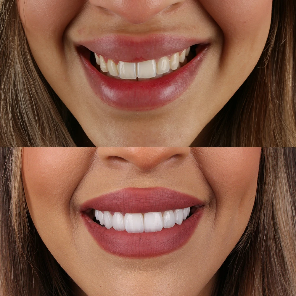 Smile Makeover