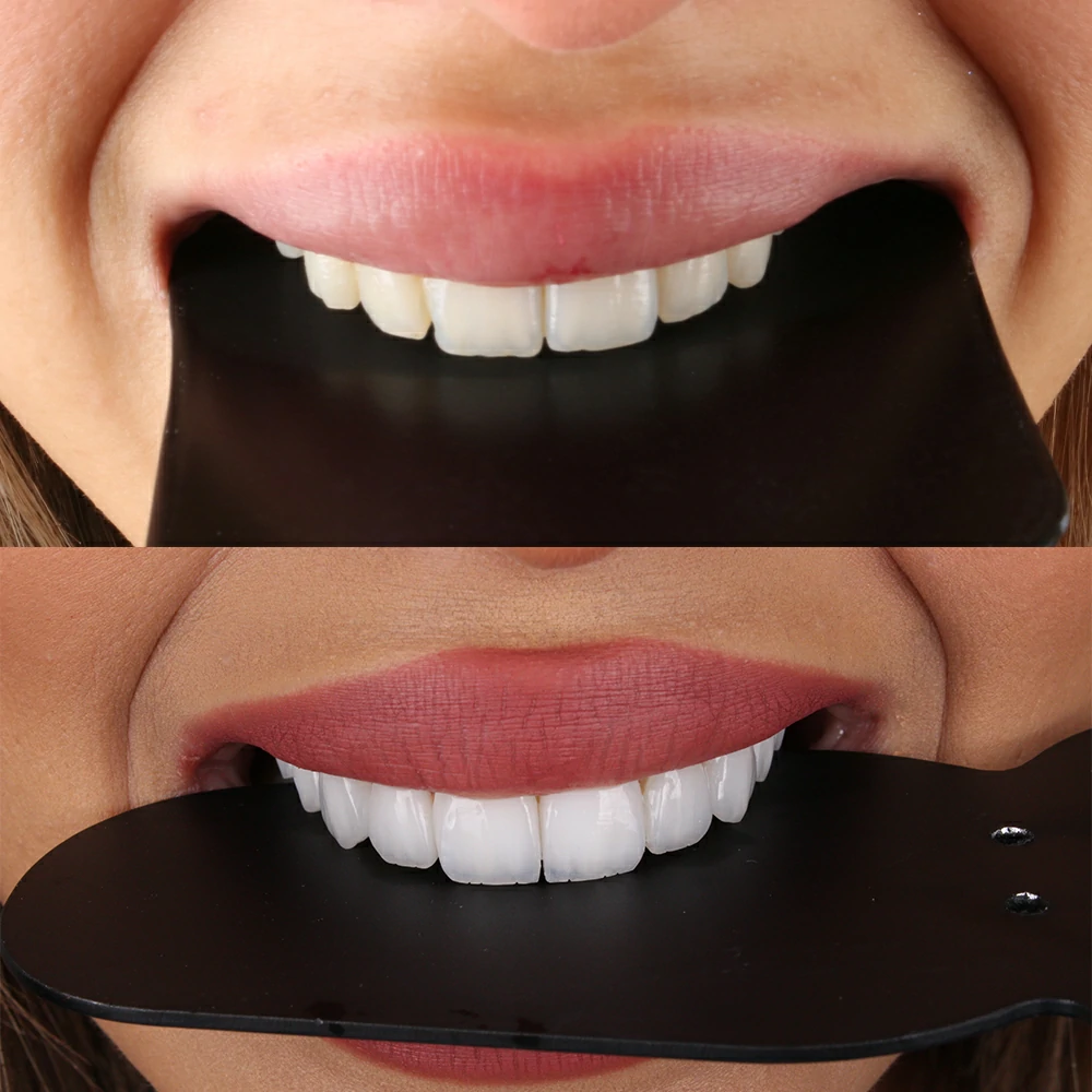 Smile Makeover
