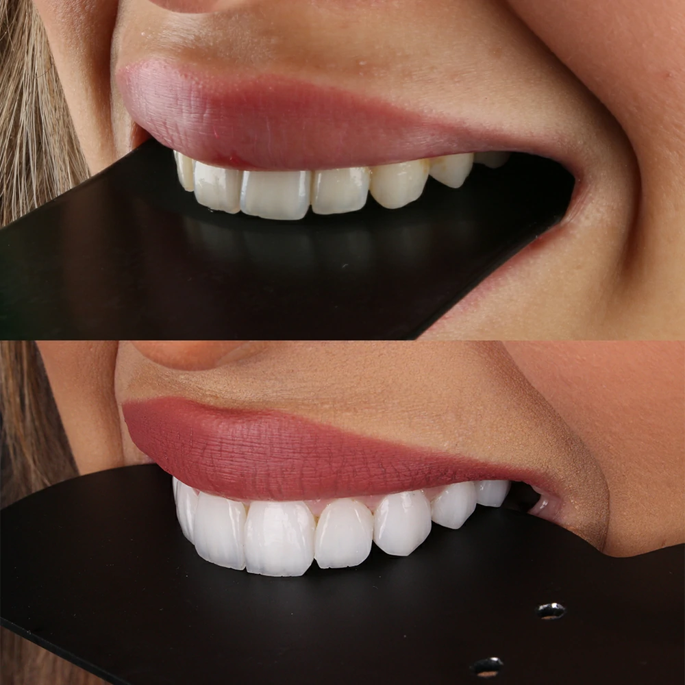 Smile Makeover