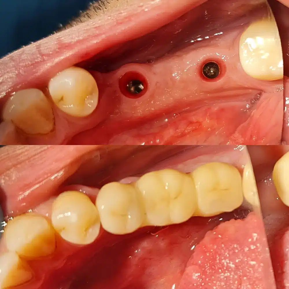 Implant Smile Restoration