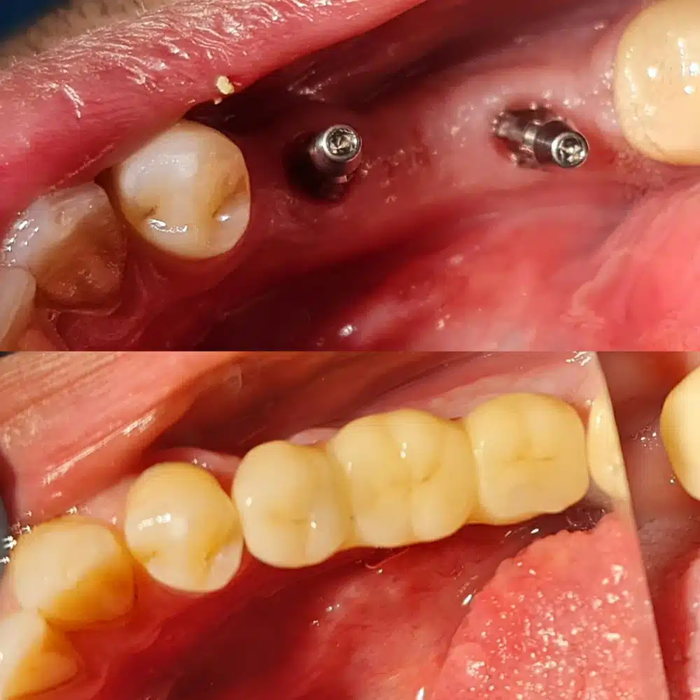 Dental Implant Renewal