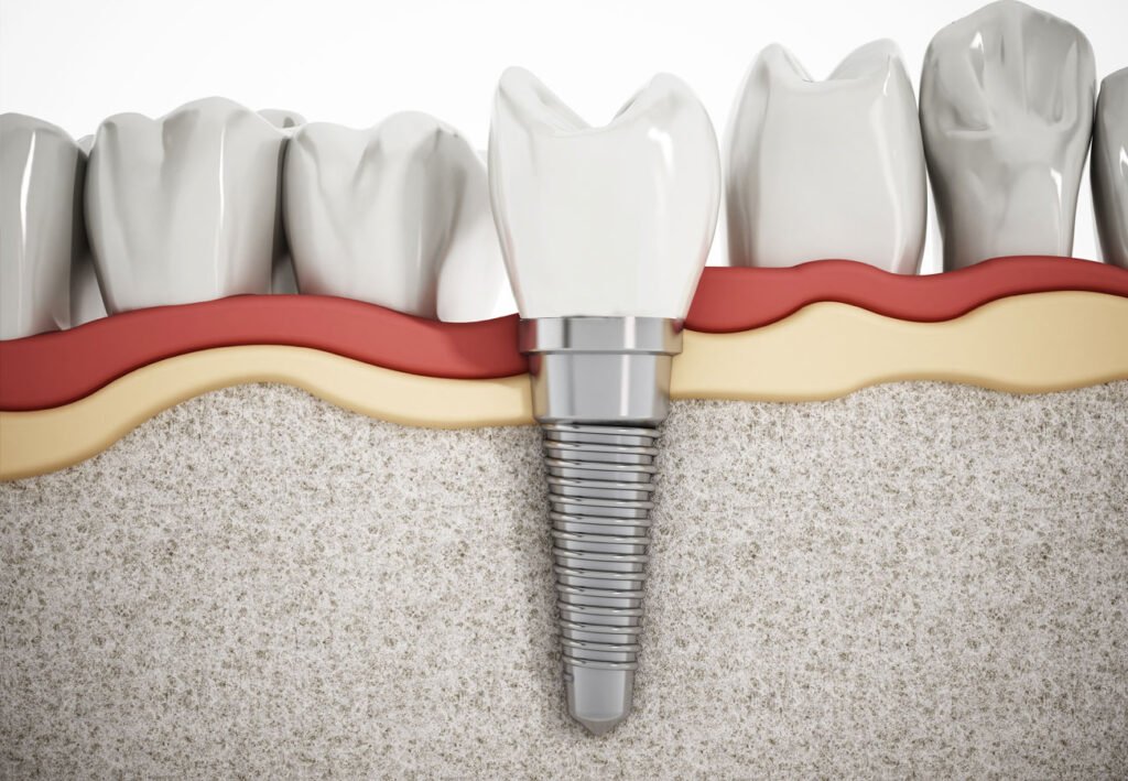 bone grafting for dental implants