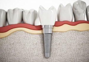 bone grafting for dental implants