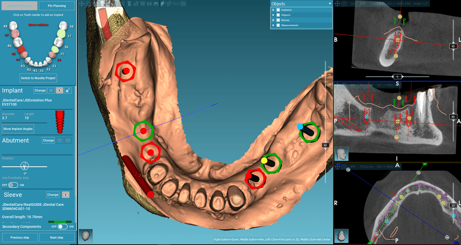 Free Consultation & 3D CBCT
