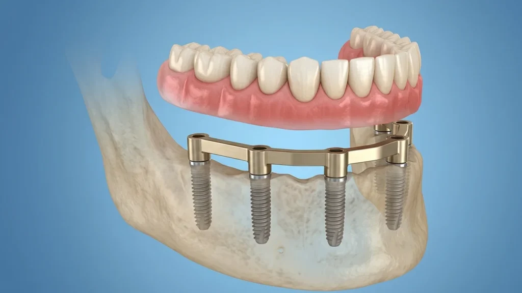 Factors Affecting the Cost of All on 4 Dental Implants