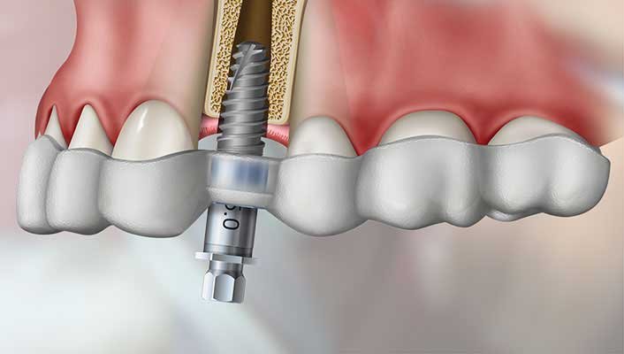 3D CBCT Guided Surgery