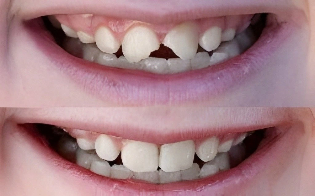 Tooth Crowns before and after