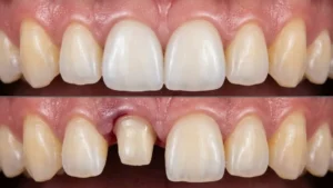 Tooth crown before and after