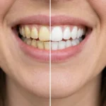 Veneer Before and After: Dr. Nidhal’s Dubai Smile Gallery