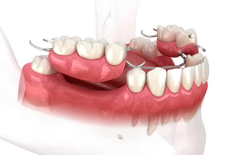 Temporary Prosthesis