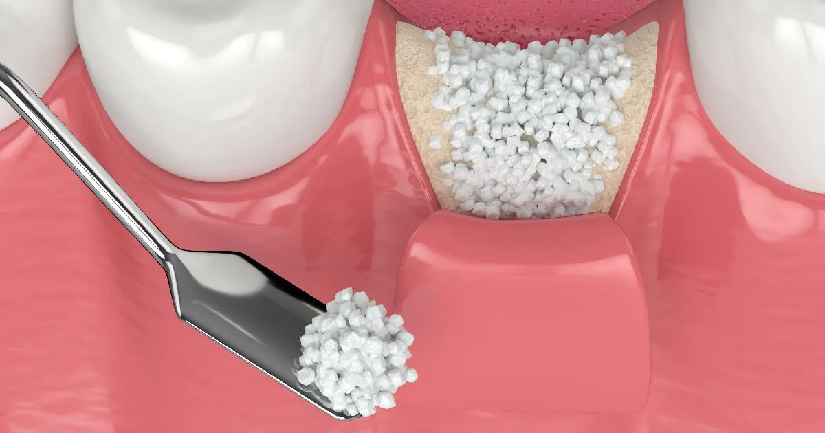 Extractions & Bone Preparation