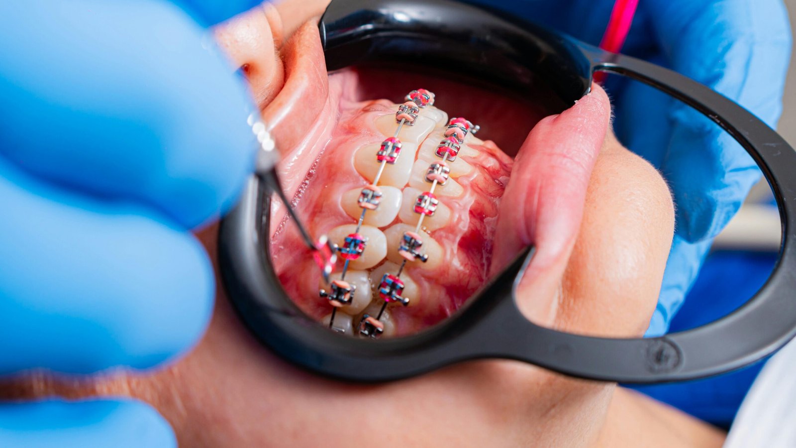 Emax Veneers