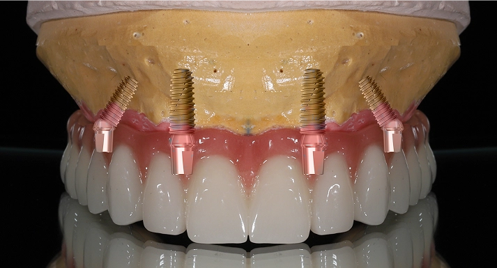 Final Zirconia Prosthesis