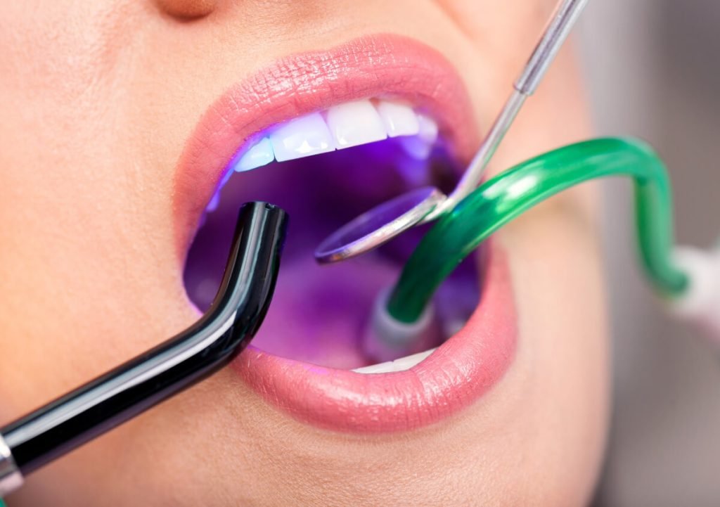 Laser Teeth Whitening Preparation Dubai