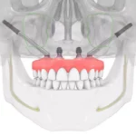 Nobel Biocare implants UAE: Your Definitive Guide to Advanced Dental