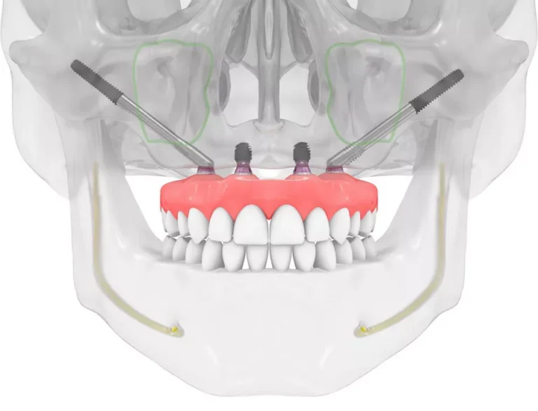 Nobel Biocare implants UAE: Your Definitive Guide to Advanced Dental