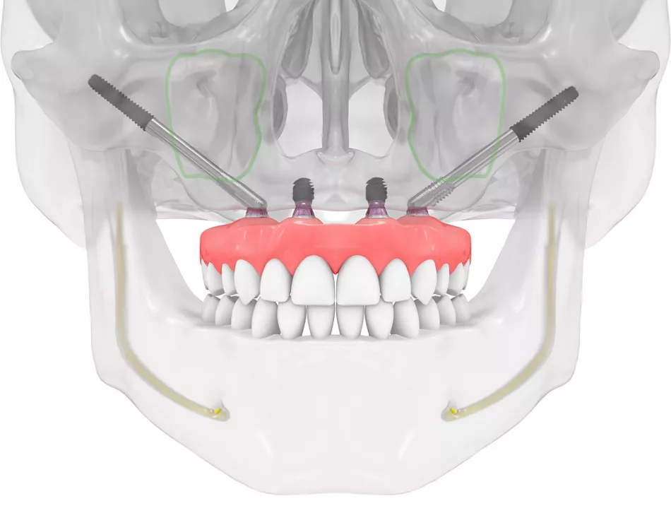 Nobel Biocare implants UAE