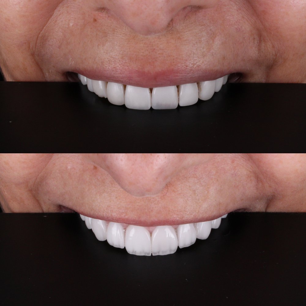 Cosmetic Veneers