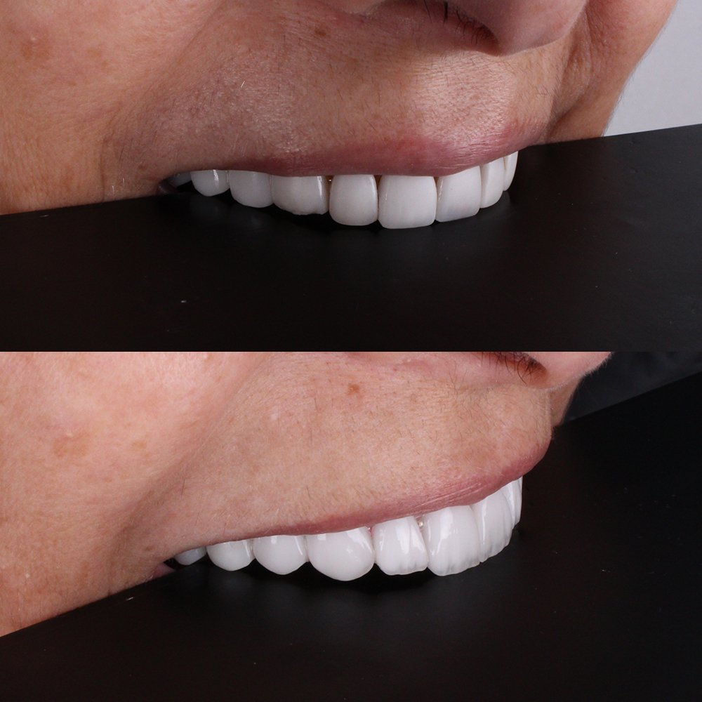 Cosmetic Veneers