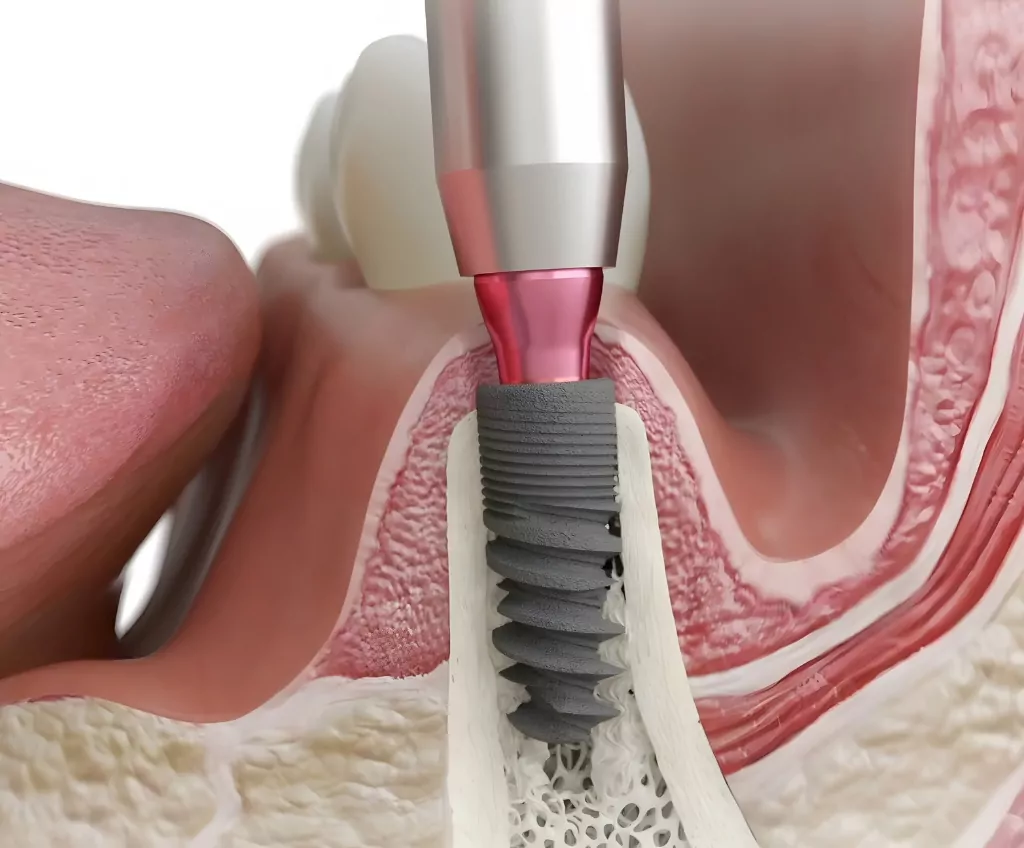 Zygomatic implant trajectory illustration