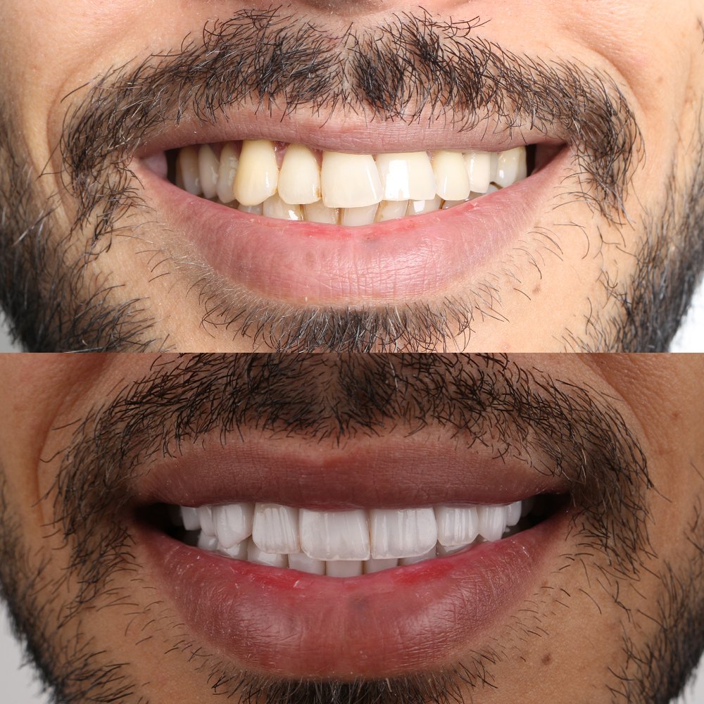 Cosmetic Veneers